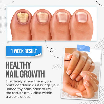 🛡️Fungus Shield Nail Treatment Cream