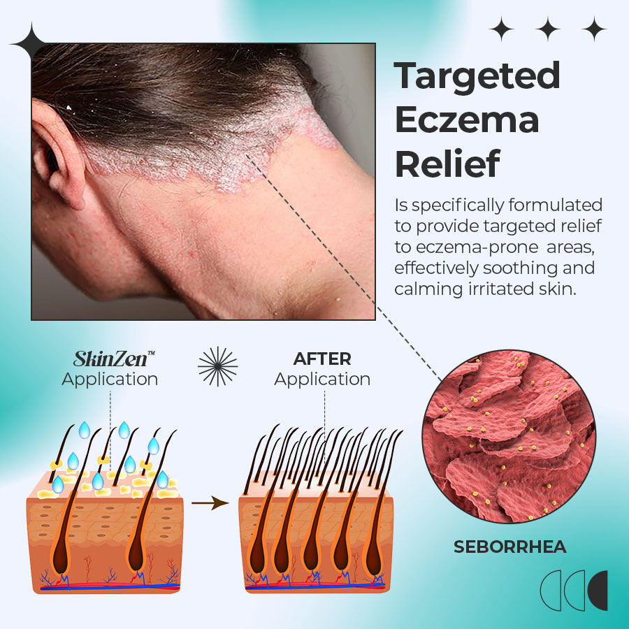 SkinZen™  Relief Eczema Roller Treatment 🌿